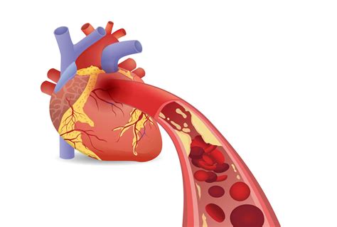 Your Coronary Arteries Cardiac Health Vrogue Co