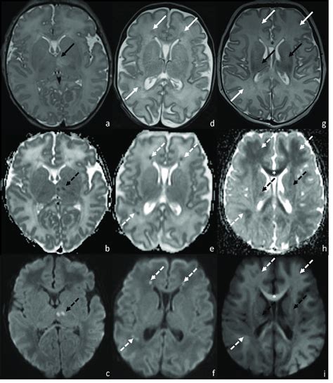 Mri0 Of Patients Affected By Hie Injury And Presenting Pattern 1