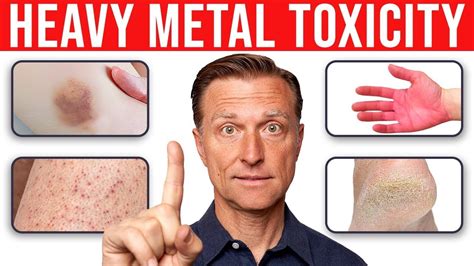4 Skin Signs That Reveal Heavy Metal Toxicity Youtube