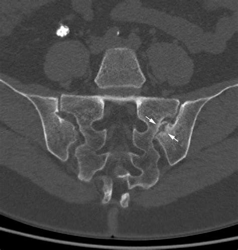 Unilateral Accessory Sacroiliac Joint With Bone Marrow Edema Mimicking