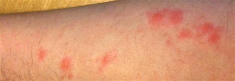 What Do Bed Bug Bites Look Like Information On Symptoms And Treatment