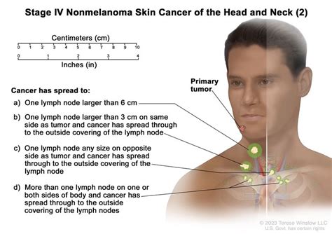 Stage Iv Nonmelanoma Skin Cancer Of The Head And Neck 2 Drawing