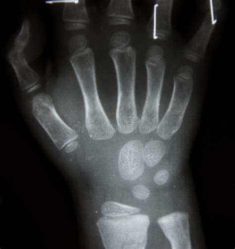 Film X Ray Normal Both Hands Of Child Stock Photo Image Of Imaging