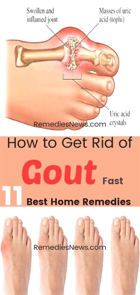 Pin On Home Remedies