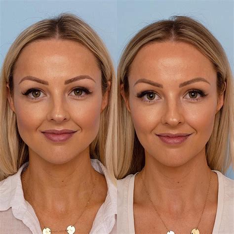 Botox In Chin Before And After