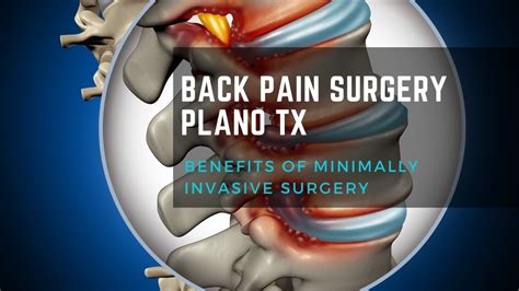 Back Pain Surgery Plano TX Benefits Of Minimally Invasive Surgery