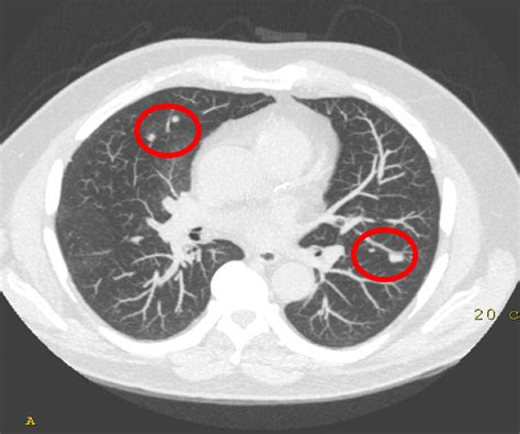 How To Deal With Incidentally Detected Pulmonary Nodules Less Than 10mm