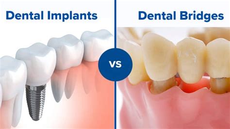 Implante dentário ou ponte que é melhor Ponte vs implante prós Cons