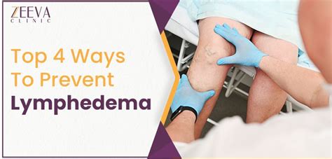 Best Natural Ways To Prevent Lymphedema Diagnosis And Treatment