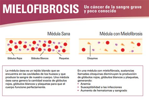 ¿sabes Que Es La Mielofibrosis