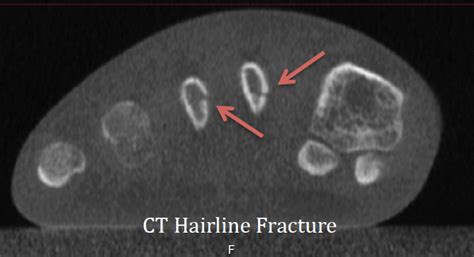 Hairline Fractures Dx W In Office Ct Imaging Curvebeam