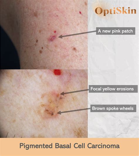 Basal Cell Carcinoma — Dermatology Skin Cancer Experts