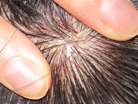 When the dye sits on the scalp for any length of time, the chemicals can actually burn the surface, leaving you with an itchy rash. scalp scabs | Flickr - Photo Sharing!