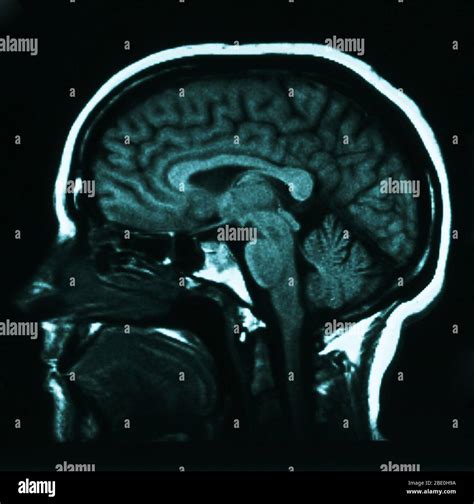 Sagittal From The Side T1 Weighted Mri Showing Normal Anatomy Of The