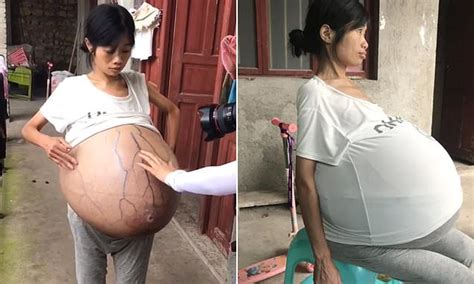 Chinese Womans Belly Grows To 44lbs Due To Mystery Condition Daily Mail Online