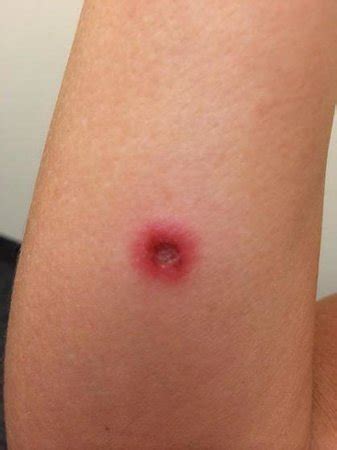 Australia is known for its large (and sometimes scary!) animals only female redback spiders have venomous bites, so take extra precautions if the spider is black with some healthy adults bitten by redback spiders experience little to no pain or other symptoms. Baja recluse spider bite - Picture of Bahia Hotel & Beach ...