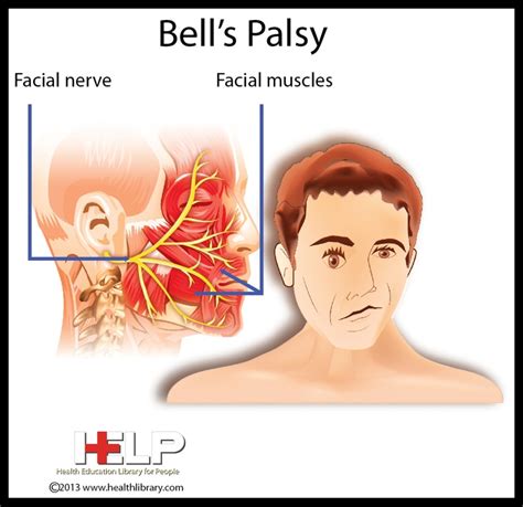 Bells Palsy Nervous System Pinterest Medical Nervous System And