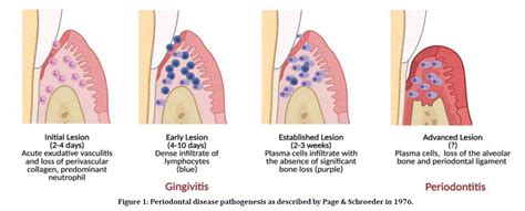 Pathogenesis Of Periodontal Pocket