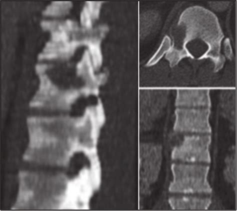 Ct Scan Of The Thoracolumbar Spine Showing Lytic Lesion Of The Right