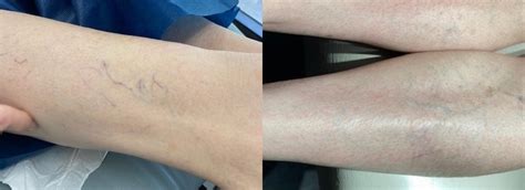 Sclerotherapy And Laser Vein Treatment Before And After Photos Patient 51