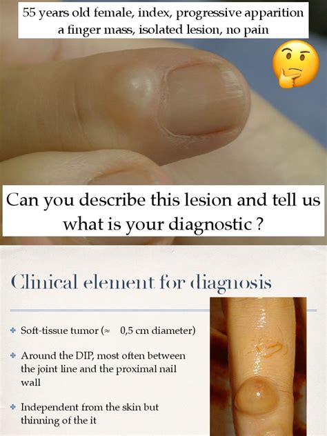 3 Clinical Cases Mucous Cyst Pdf Nail Anatomy Surgery