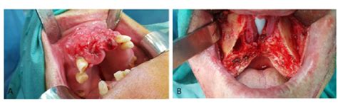 Oral Squamous Cell Carcinoma Of The Upper Maxilla A Intraoral View