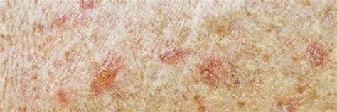 Actinic Keratosis Lesions Treatment Options Healthcentral