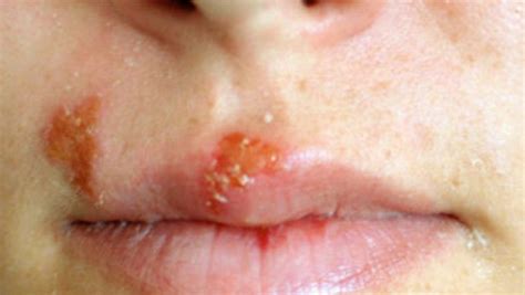 Why You Should Avoid Exfoliating Your Lips If You Have A Cold Sore