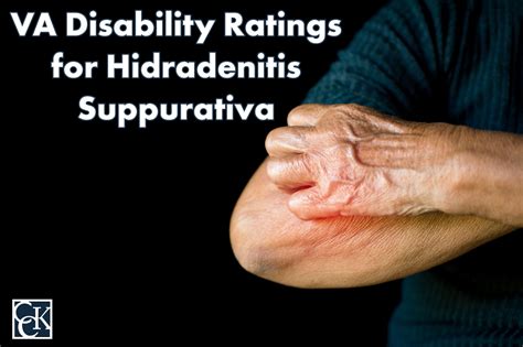 Va Disability Ratings For Hidradenitis Suppurativa Cck Law