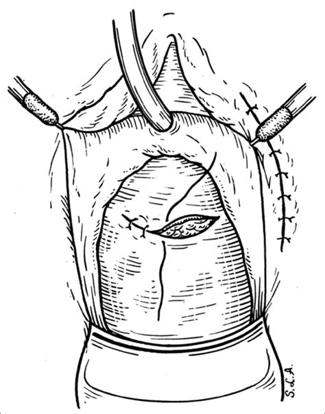 The Incisions Over The Labia Majora Pudenda And Vagina Are Sutured