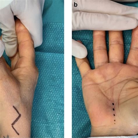 Double Incision Approach For Concomitant Carpal Tunnel Syndrome And