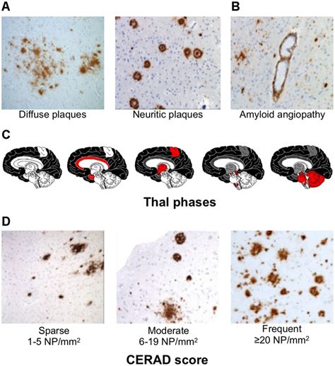 The Role Of Amyloid Pet In Imaging Neurodegenerative Disorders A