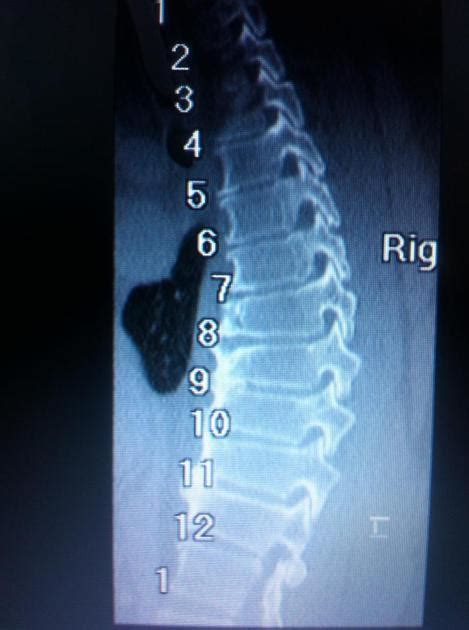 Scheuermann Kyphosis Bone And Spine