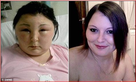 Welcome To Boma Peters Blog Shocking Pictures Show Swollen Face Of Woman After Allergic