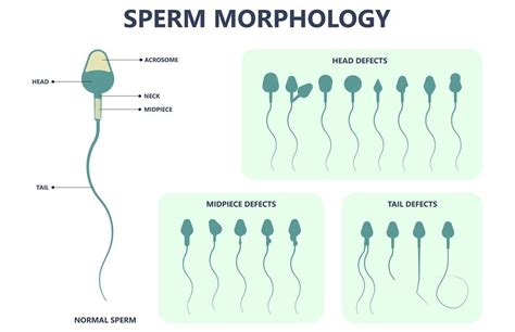 Sperm Morphology How Sperm Shape Affects Male Fertility