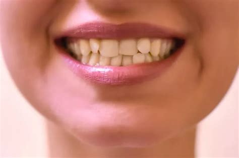 Susunan Gigi Tidak Rapi Benarkah Pengaruh Faktor Genetik