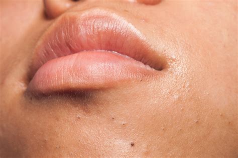 Blackheads On Chin Causes Facts And Home Remedies