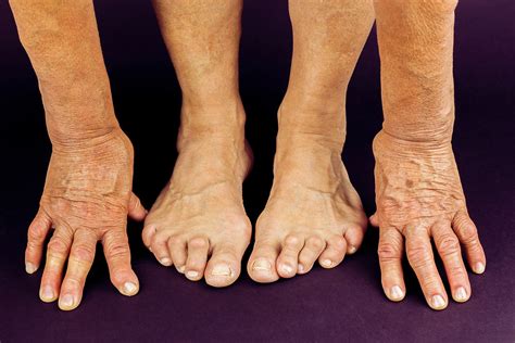 How Acupuncture Reduces Swelling And Pain In Rheumatoid Arthritis
