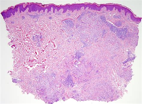 Granuloma Annulare Histology