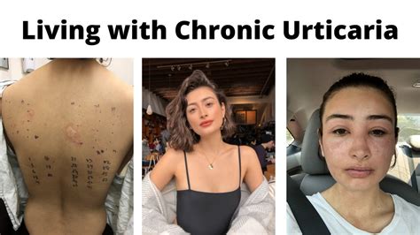 Living With Chronic Urticaria My First Flareup Qanda Autoimmune