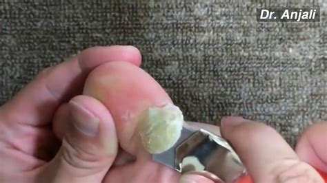 Removal Giant Calluses On Toes At Home Youtube