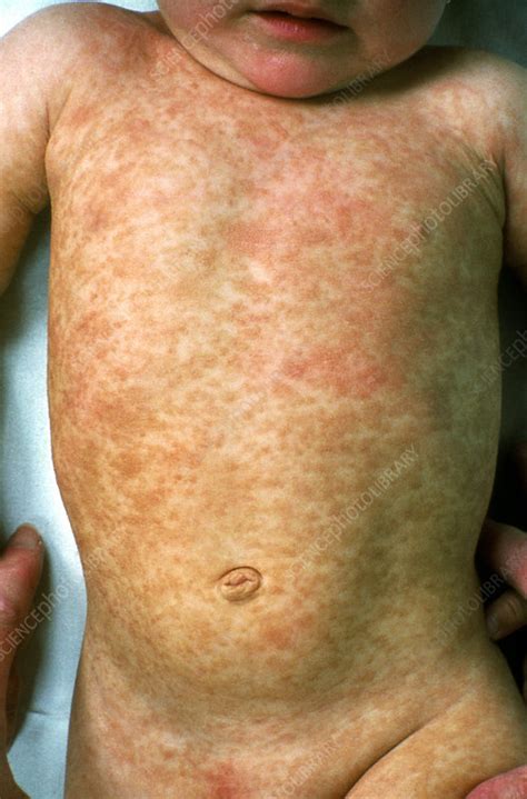 Urticaria Pigmentoseon Childs Body Stock Image M2800010 Science