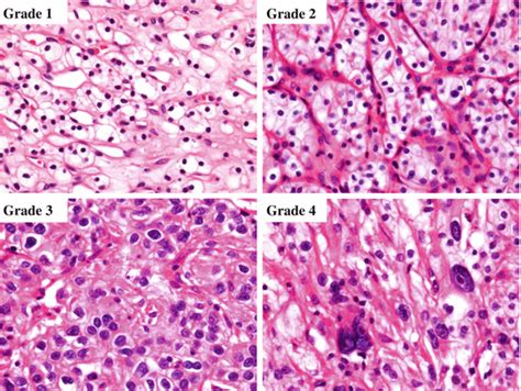 Pathology Of Renal Cell Carcinoma Oncohema Key