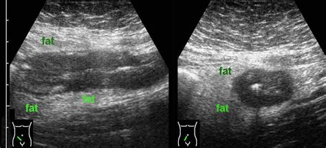 Crohns Disease Ultrasound