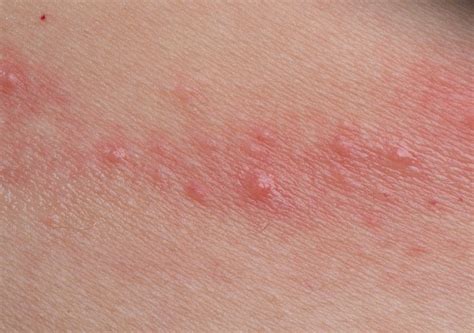Una Guía Sobre Las Causas Comunes De La Dermatitis De Contacto