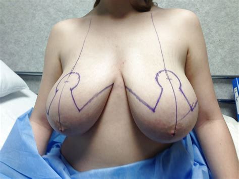 pre breast reduction tits 2 94 pics xhamster