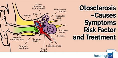 Otosclerosis Is An Ear Disease Which Causes Hearing Loss In This Case