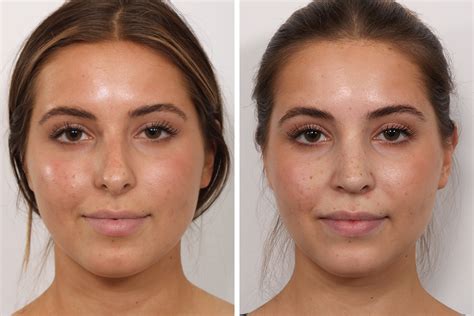 Top Celebrity Rhinoplasty Surgeon Natural Looking Nose Job Surgery For