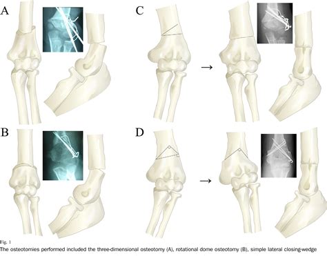 Figure 1 From Supracondylar Osteotomy Of The Humerus To Correct Cubitus