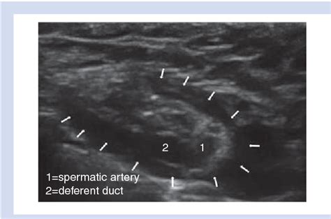 Figure 1 From Ultrasound Guided Spermatic Cord Block For Scrotal